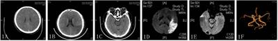 Suitability of Thrombolysis for Patients With Acute Ischemic Stroke Complicated With Trousseau Syndrome